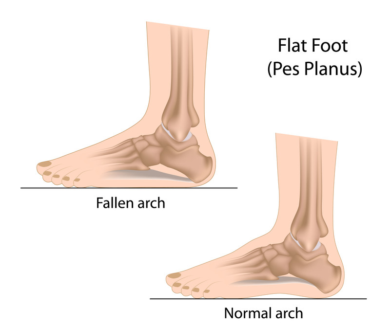 Plantar Fasciitis and Pes Planus VA Rating