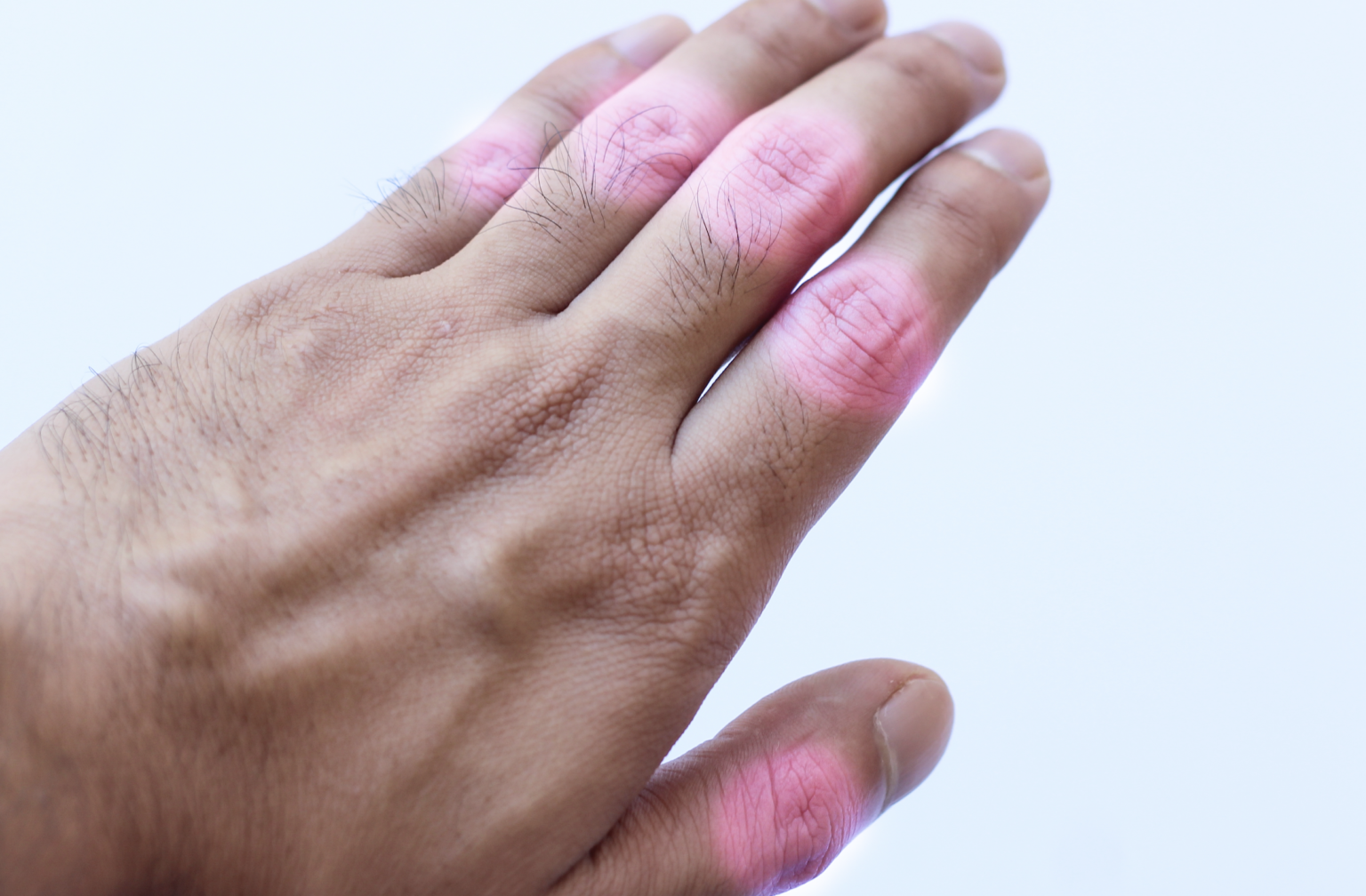 How VA Rates Arthritis for Disability Benefits VET CLAIM SOLUTIONS