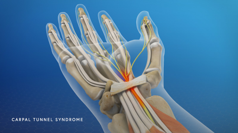 CARPAL TUNNEL SYNDROME & DISABILITY