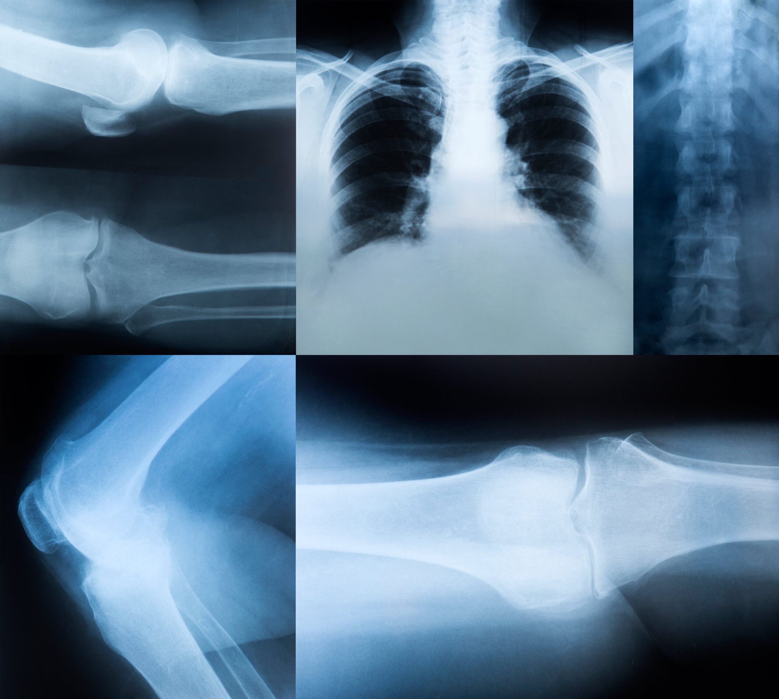 Medical diagram highlighting common osteoporosis-related fracture risk areas such as: hips, spine, and wrists. 