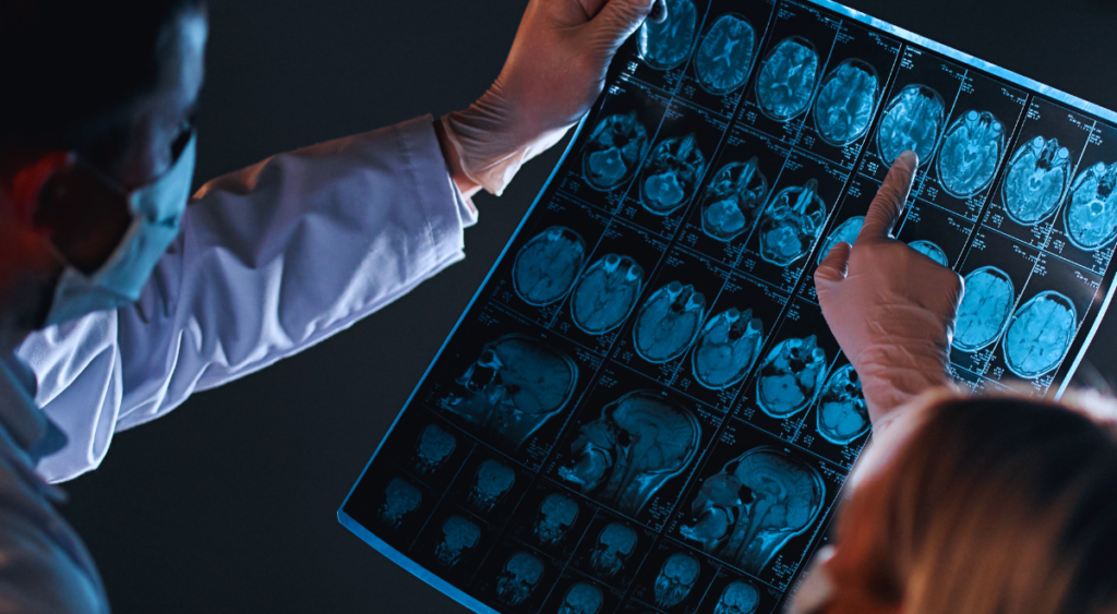A doctor carefully examines a CT scan, searching for signs of traumatic brain injury. For many veterans, TBIs stem from blast exposures, training accidents, or falls, with symptoms ranging from dizziness to memory loss—sometimes surfacing years later. Proper diagnosis and thorough documentation are essential steps in securing VA benefits.