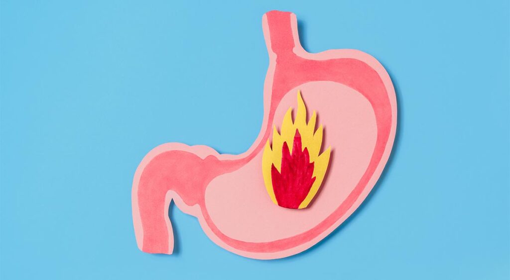 This illustration of acid reflux highlights how conditions like GERD can be linked to hemorrhoids through strain, irritation, and digestive issues.