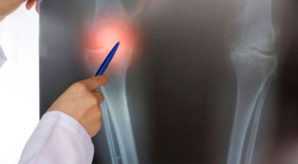 A doctor pointing to a knee joint X-ray helps explain bone spurs — extra bone growths that can cause pain and affect movement.
